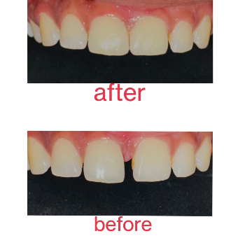 Composite Restoration