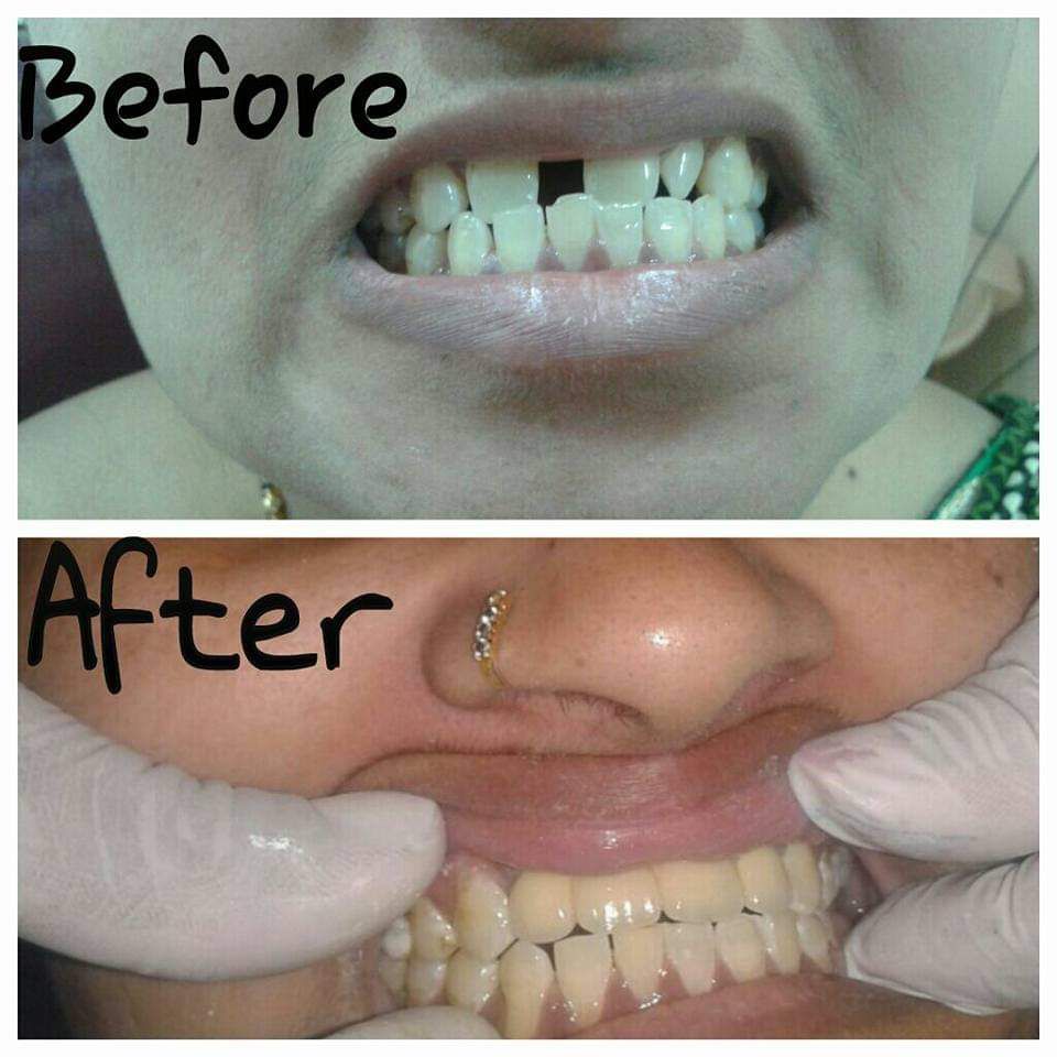 Composite Bonding Before After