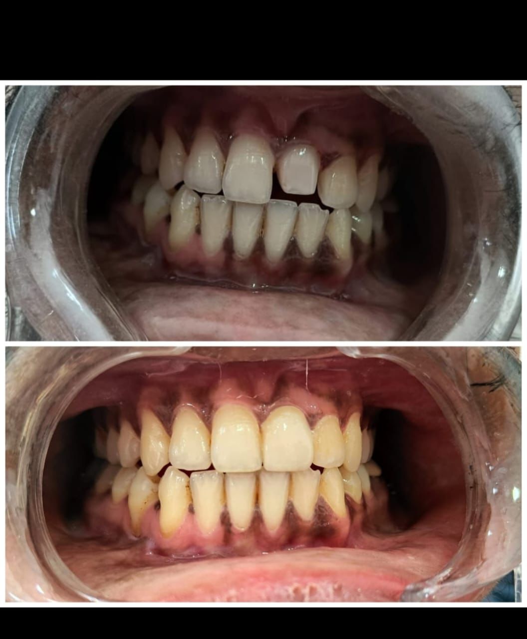 Tooth Restoration Before After