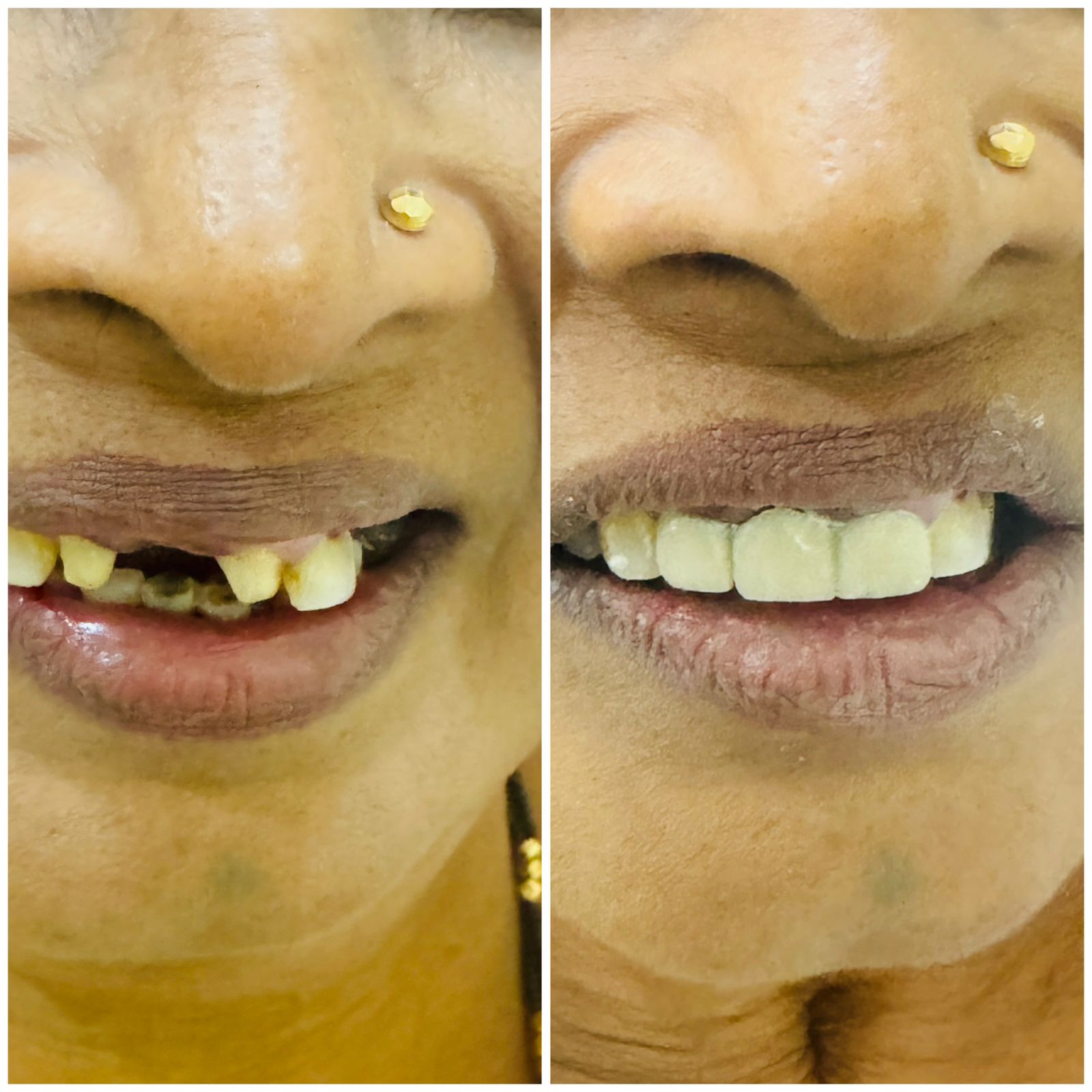 Crown Restoration Before After