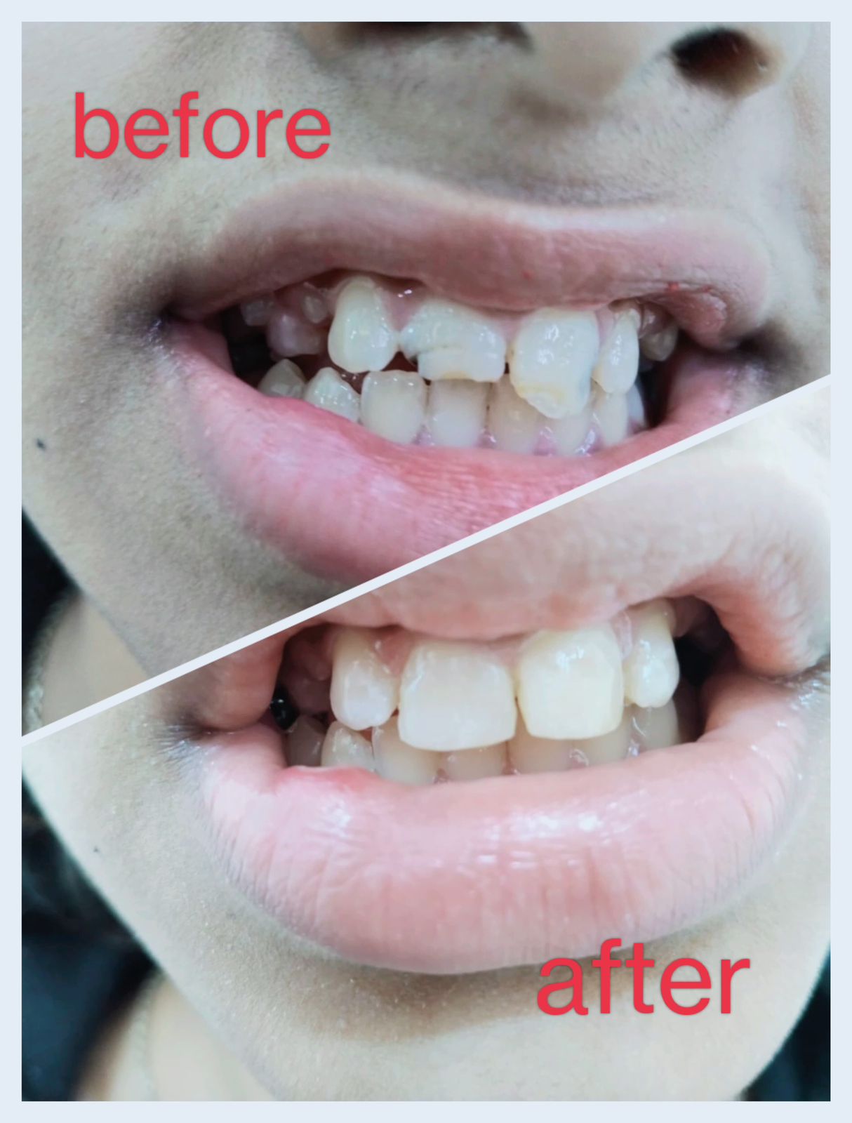 Tooth Extraction Before After