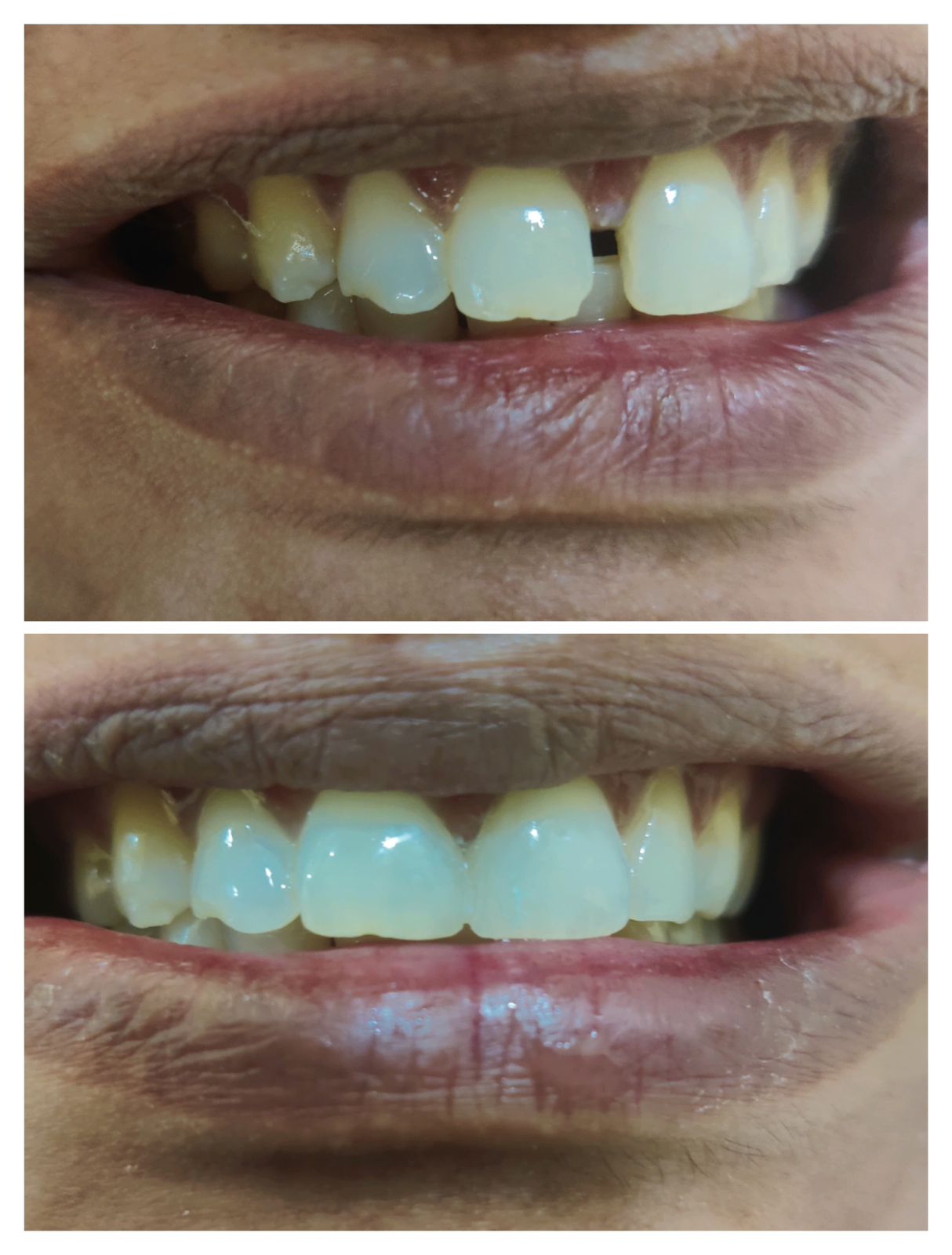 Full Mouth Rehabilitation