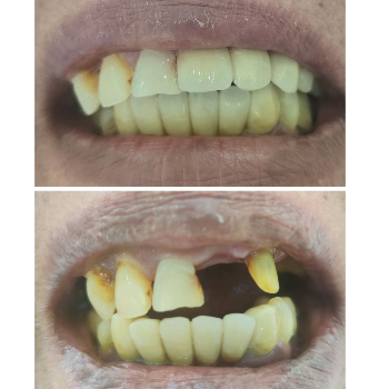 Dental Implant Before After