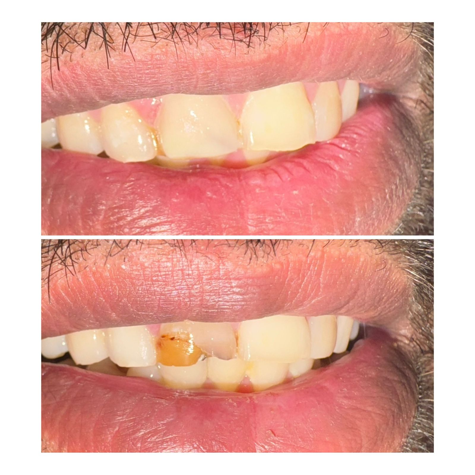 Implant Restoration Before After