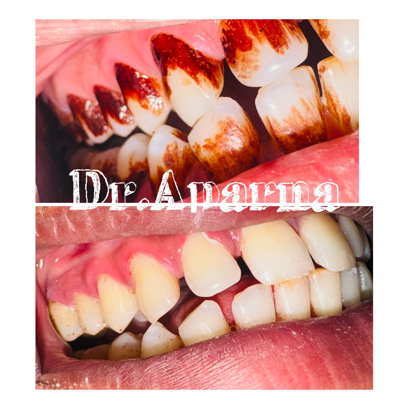 Scaling & Cleaning Before After