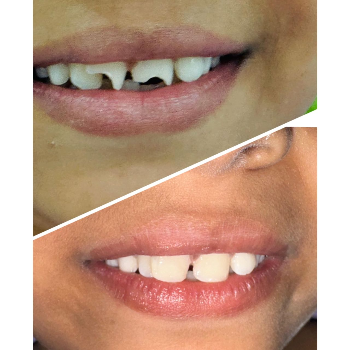 Smile Makeover Before After