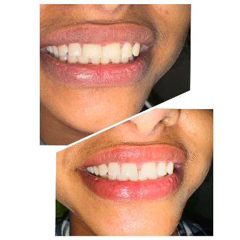 Teeth Whitening Before After
