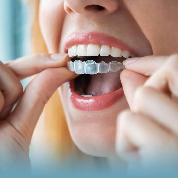 Invisalign & Clear Aligners